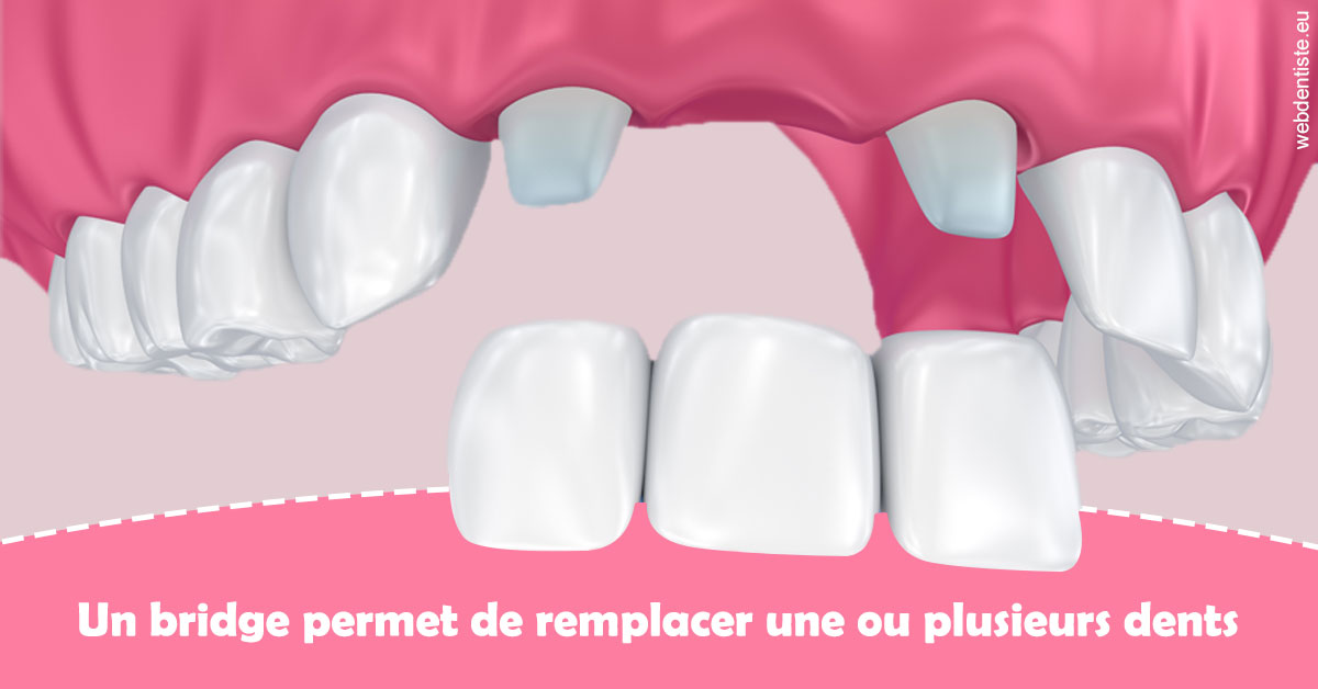 https://www.dr-falanga-henri-jean.fr/Bridge remplacer dents 2