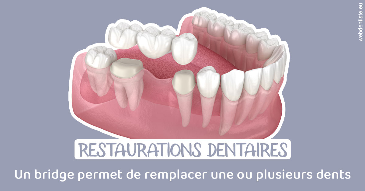 https://www.dr-falanga-henri-jean.fr/Bridge remplacer dents 1