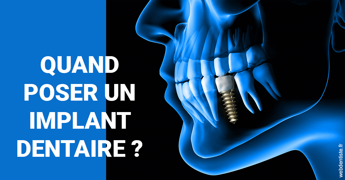 https://www.dr-falanga-henri-jean.fr/Les implants 1