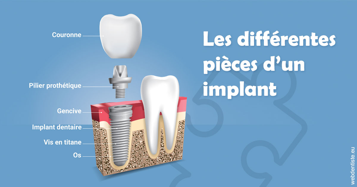 https://www.dr-falanga-henri-jean.fr/Les différentes pièces d’un implant 1