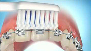 Nettoyage des brackets avec du fil dentaire